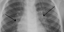 Bronquiolite é a principal causa de internação em bebês